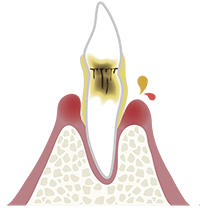 歯周炎（中等度）